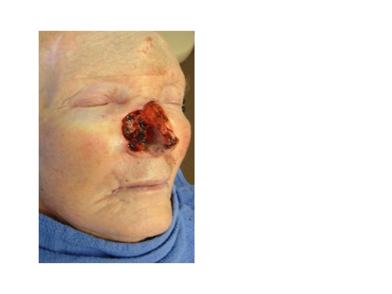 Skin Cancer Facial Reconstruction