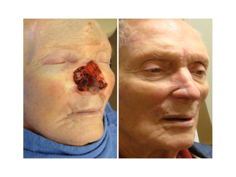 Skin Cancer Facial Reconstruction
