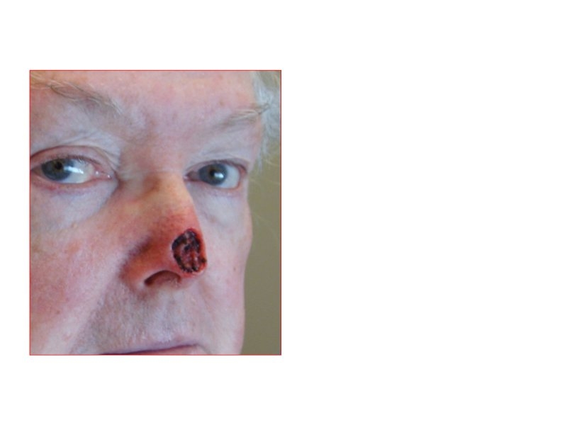 Skin Cancer Facial Reconstruction