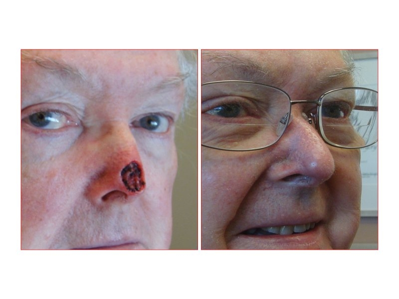 Skin Cancer Facial Reconstruction