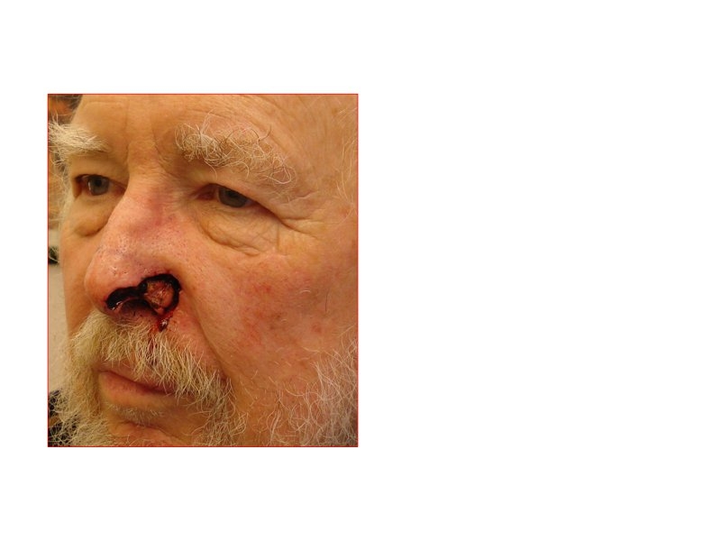 Skin Cancer Facial Reconstruction