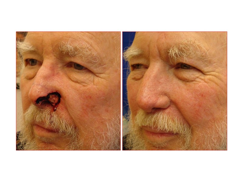 Skin Cancer Facial Reconstruction