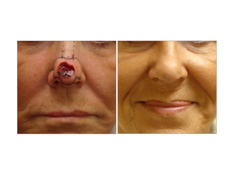 Skin Cancer Facial Reconstruction