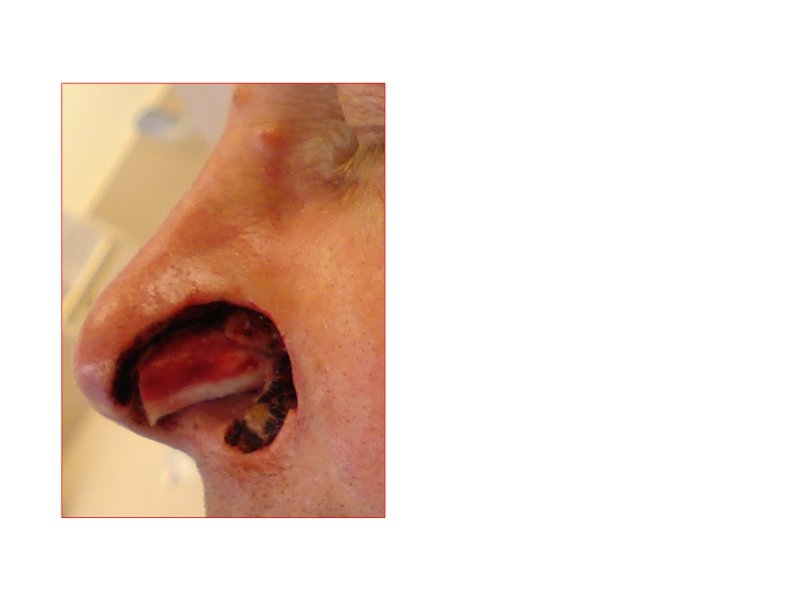 Skin Cancer Facial Reconstruction