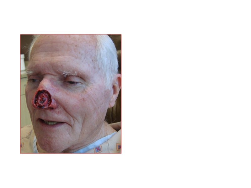Skin Cancer Facial Reconstruction