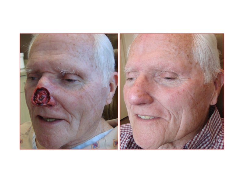 Skin Cancer Facial Reconstruction