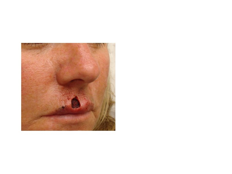 Skin Cancer Facial Reconstruction