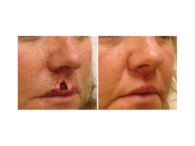 Skin Cancer Facial Reconstruction