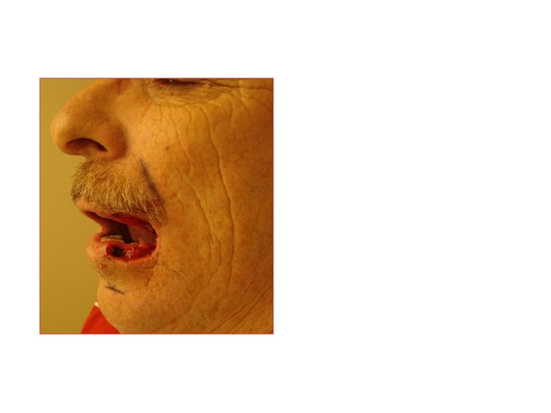 Skin Cancer Facial Reconstruction