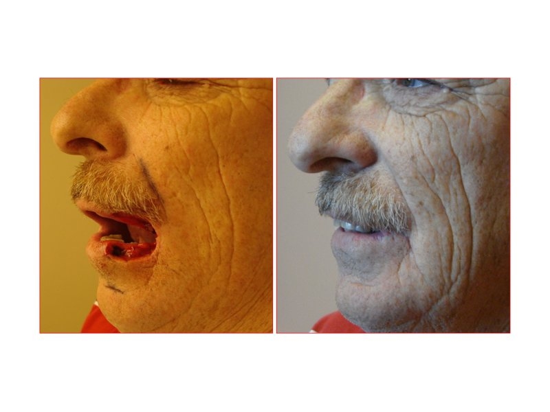 Skin Cancer Facial Reconstruction