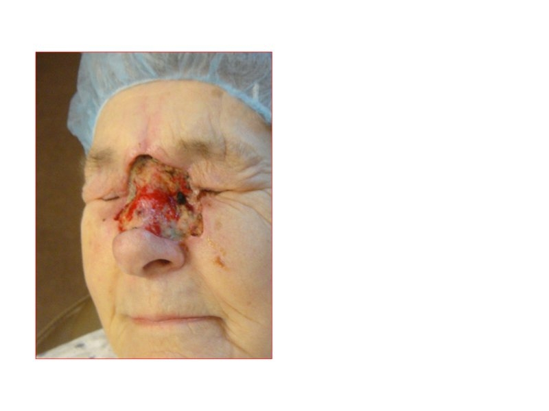 Skin Cancer Facial Reconstruction