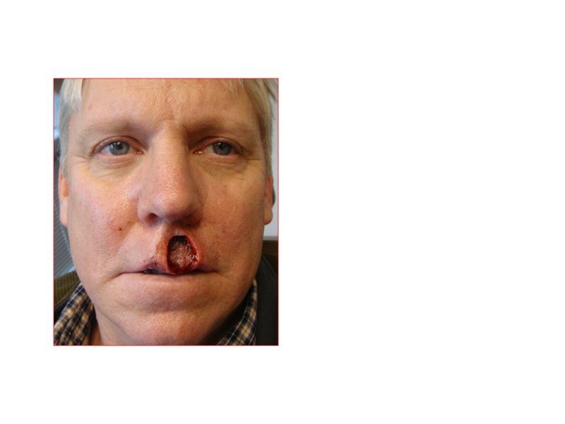Skin Cancer Facial Reconstruction